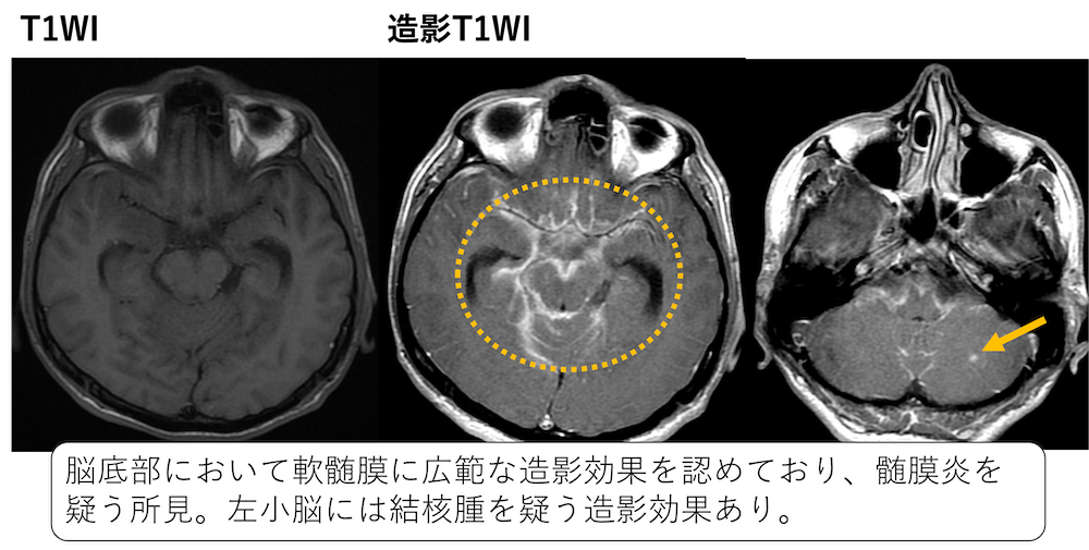 髄膜炎の画像診断(MRI、CT所見)まとめ